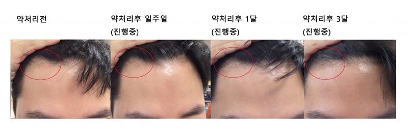 타코완료 3달.jpg