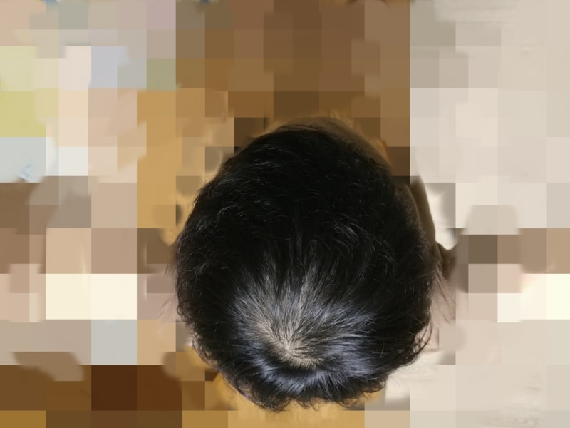 2 미녹시딜 시작전.jpg
