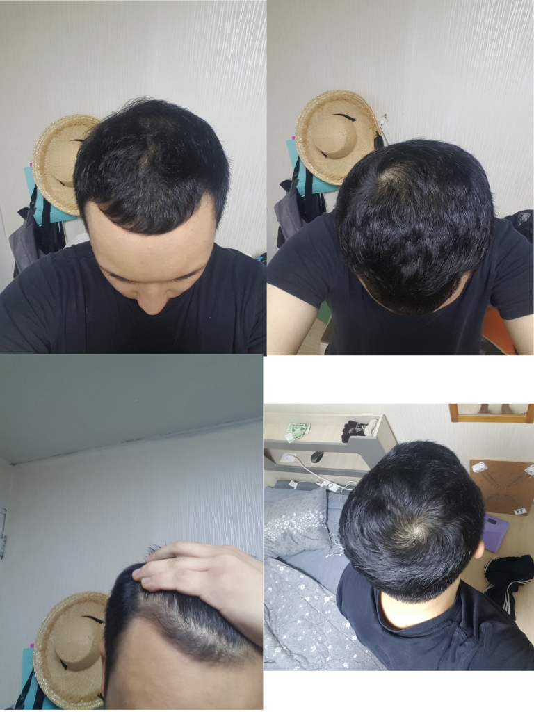 복용3개월.jpg