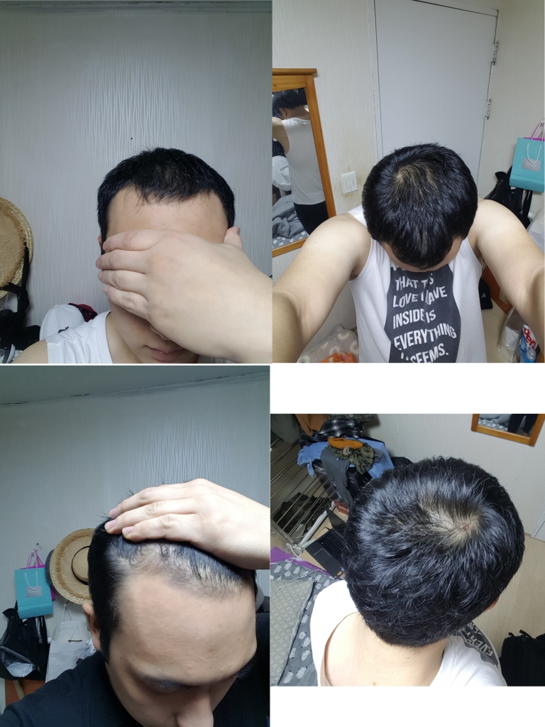 복용2개월.jpg