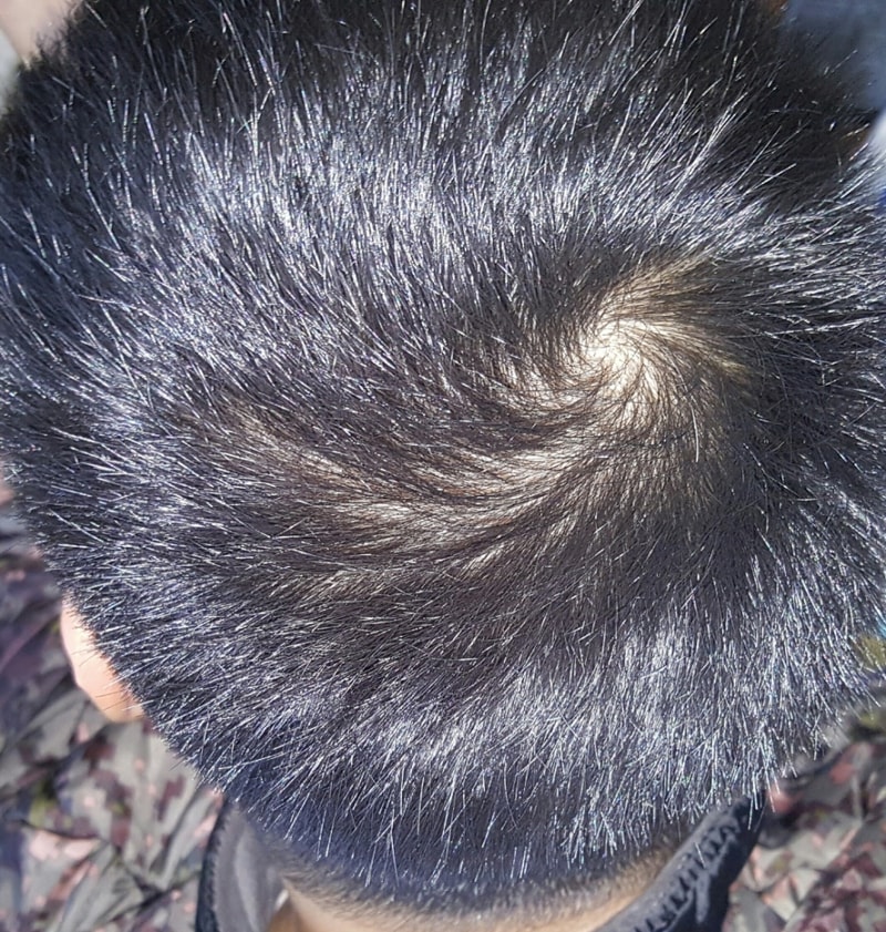 정수리.jpg