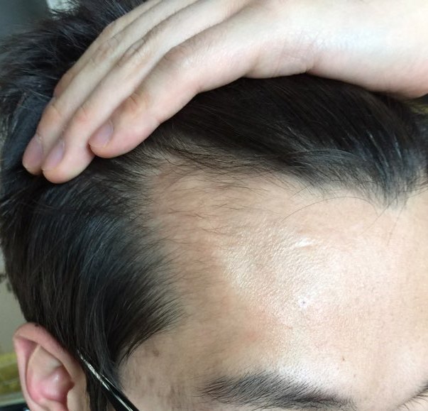 미녹시딜 후 5.jpg
