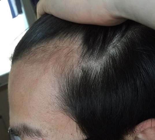 미녹시딜 후 3.jpg