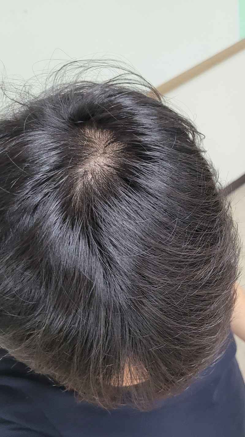 먹은 후 정수리 2.jpg