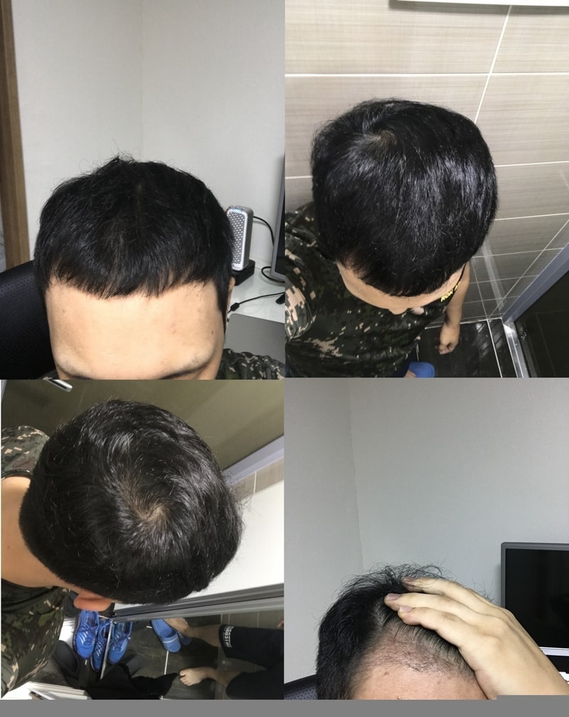 복용10개월.jpg