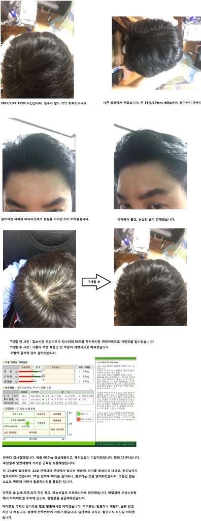 탈모2.jpg