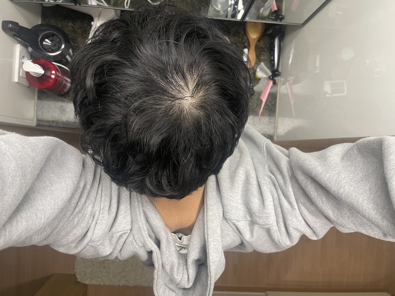 원형(정수리) 탈모 극복 후기
