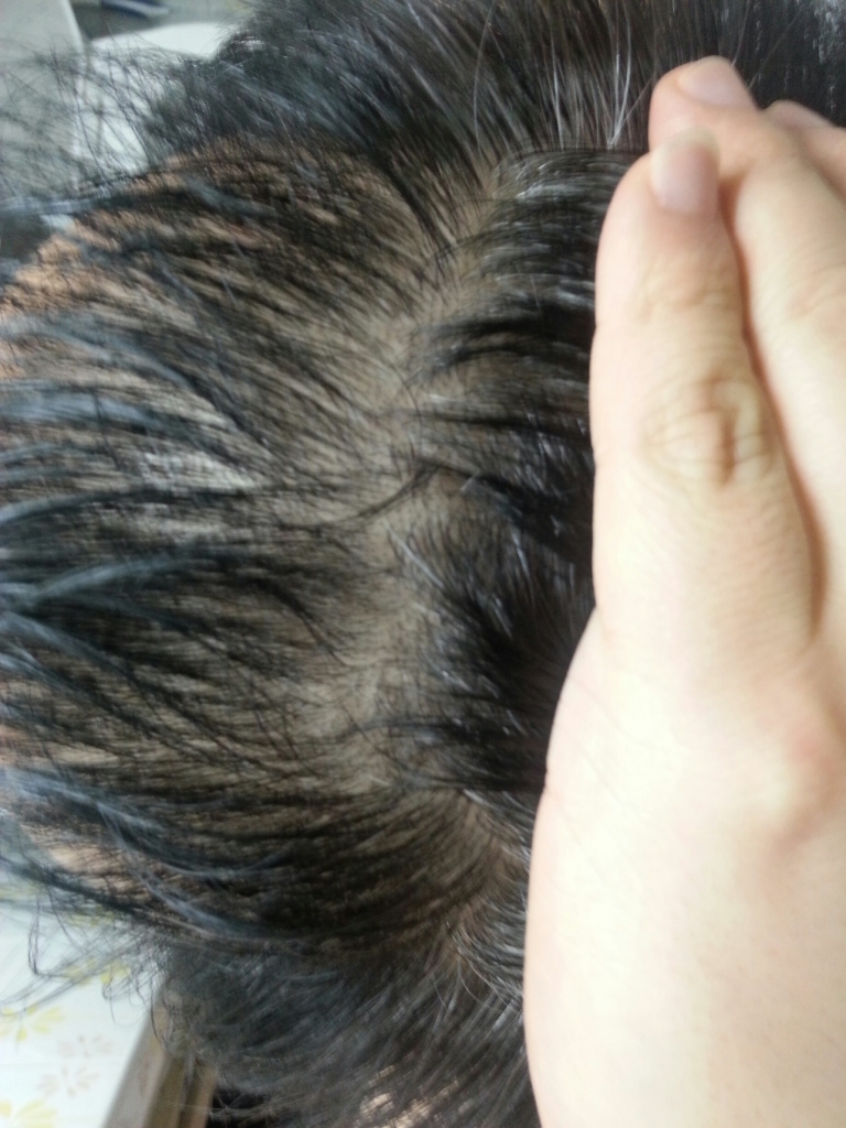 복용후1달03.jpg