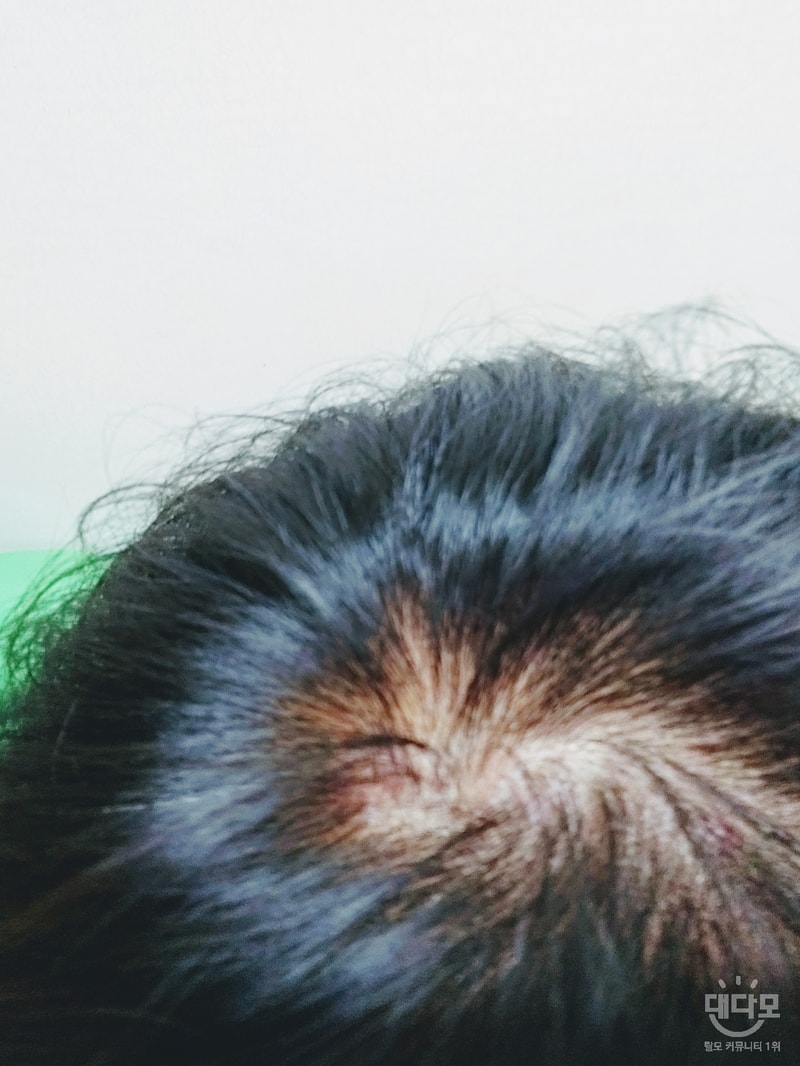 정수리.jpg