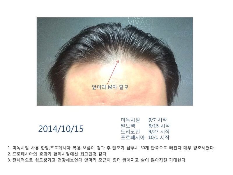 탈모극복기ㄹㄹ.jpg