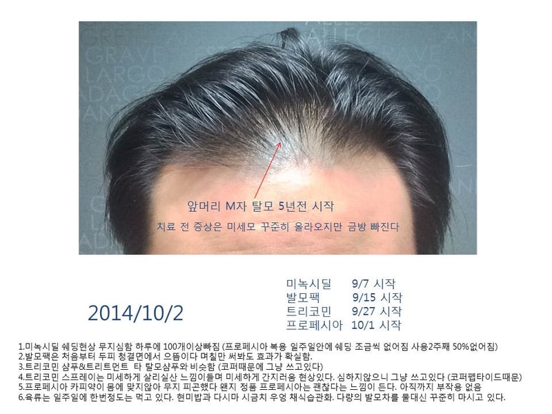 탈모극복기111.jpg