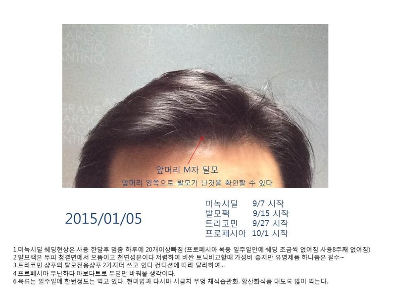 탈모극복기.jpg