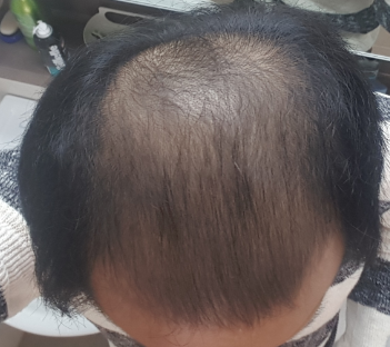 치료 2개월째.png