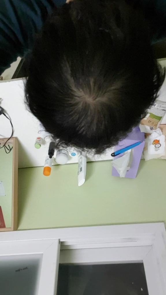 alopecia-20180714-144304-000-resize.png