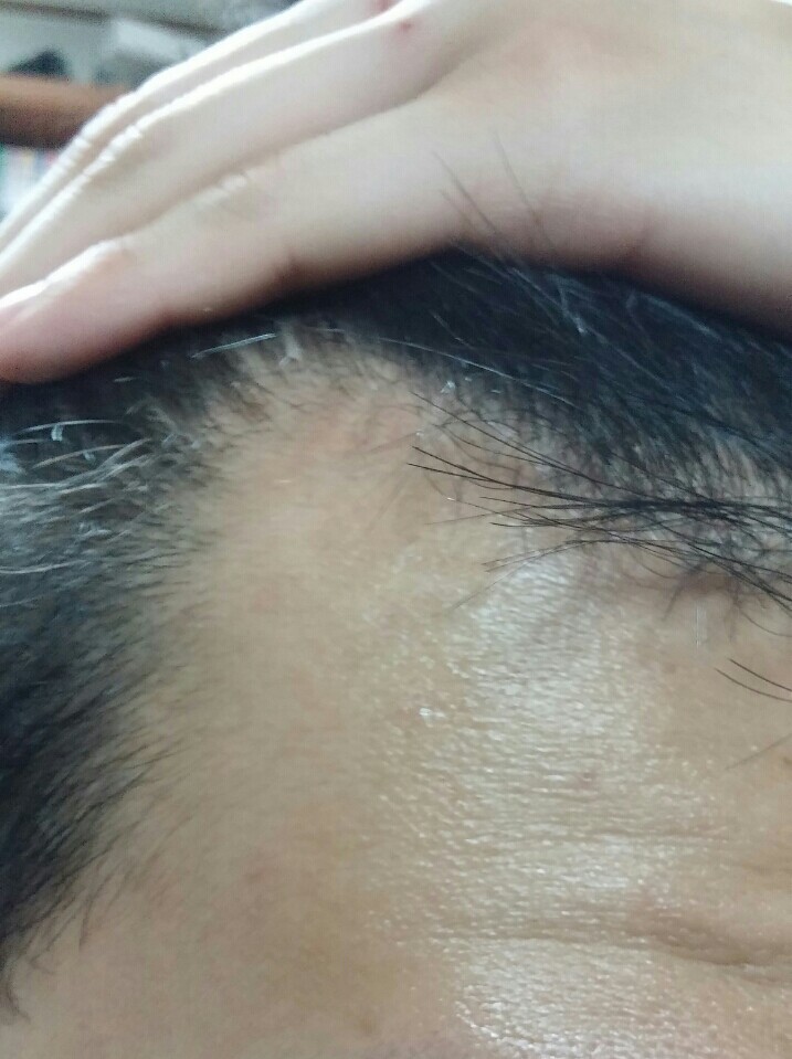 이마 시작2.jpg