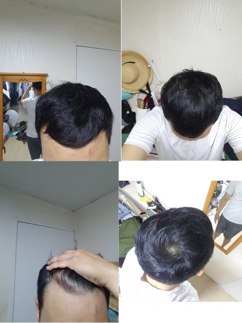 복용6개월.jpg