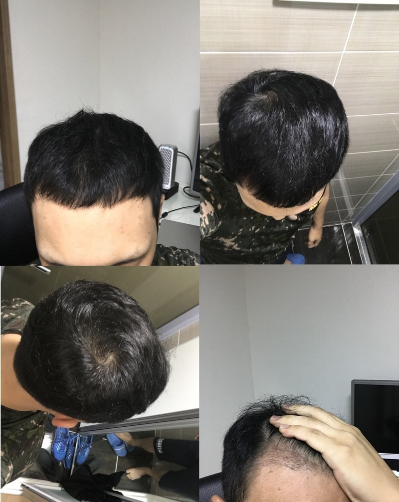 복용10개월.jpg