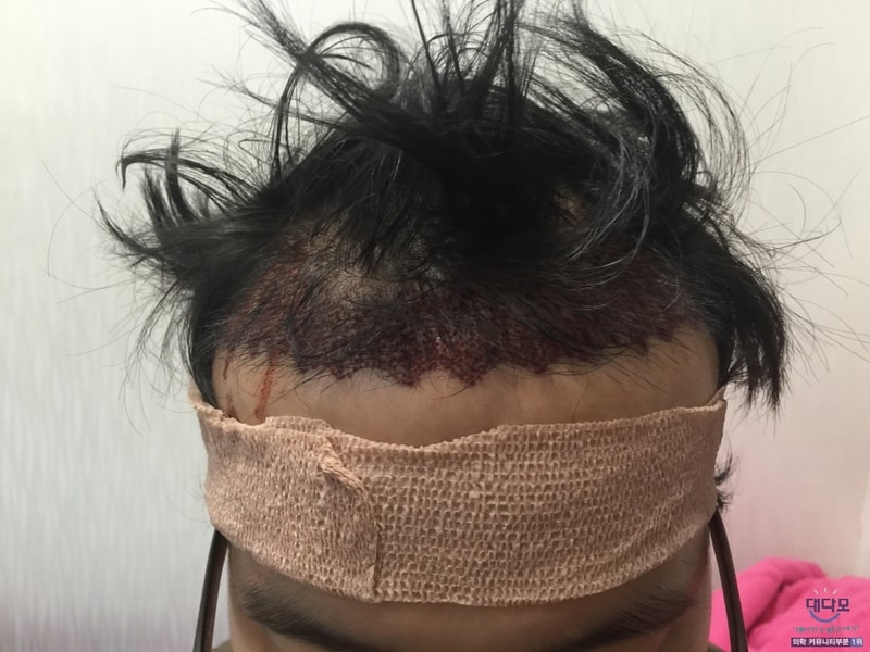 모발이식 후.jpg