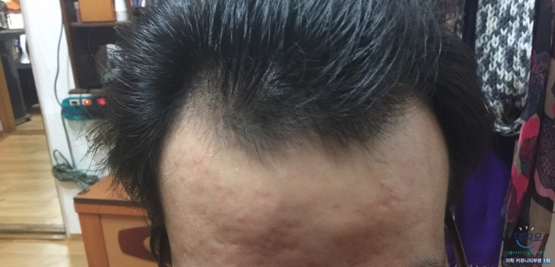 모발이식 전.jpg