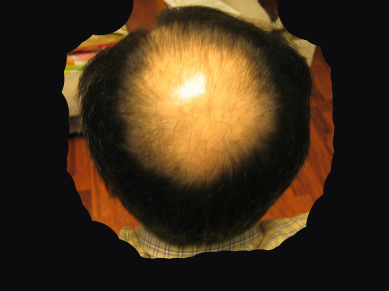 1preOP-v.jpg