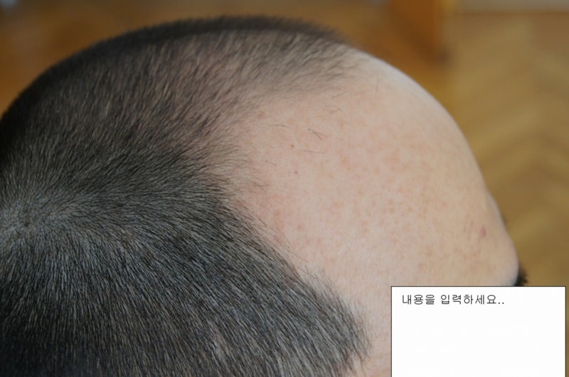 수술전 측면.jpg