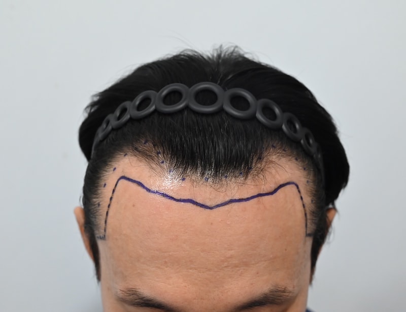 모발이식 전(디자인).jpg