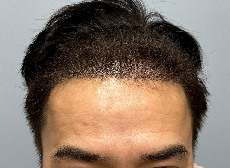 앞(후).png