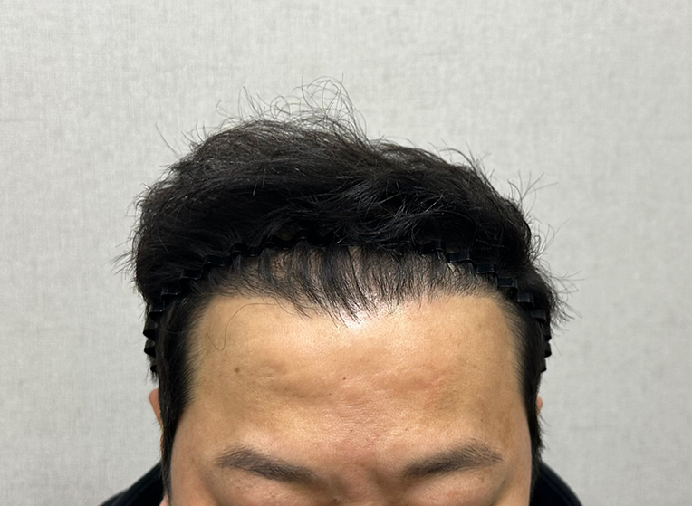 앞(후).png