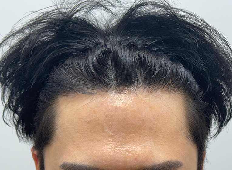 앞(후).png