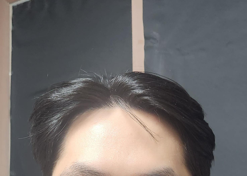 김효성_1년경과_셀카 (1).png