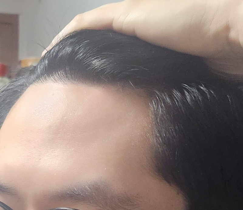 김효성_1년경과_셀카 (2).png