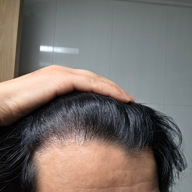 박병규 10개월 경과셀카사진.png