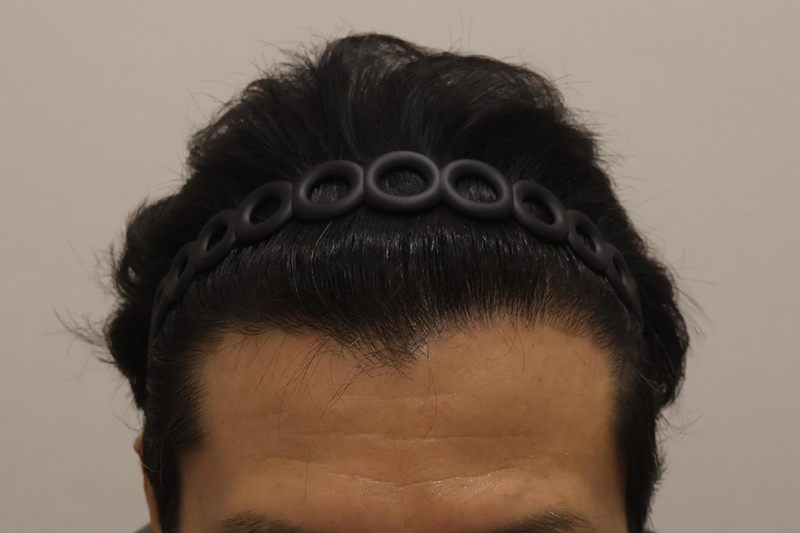 9개월경과 이미 편집 완료된것(이건 보정 안해도되요).png
