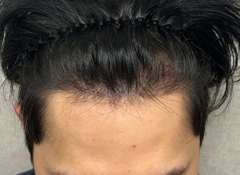 앞(후).png