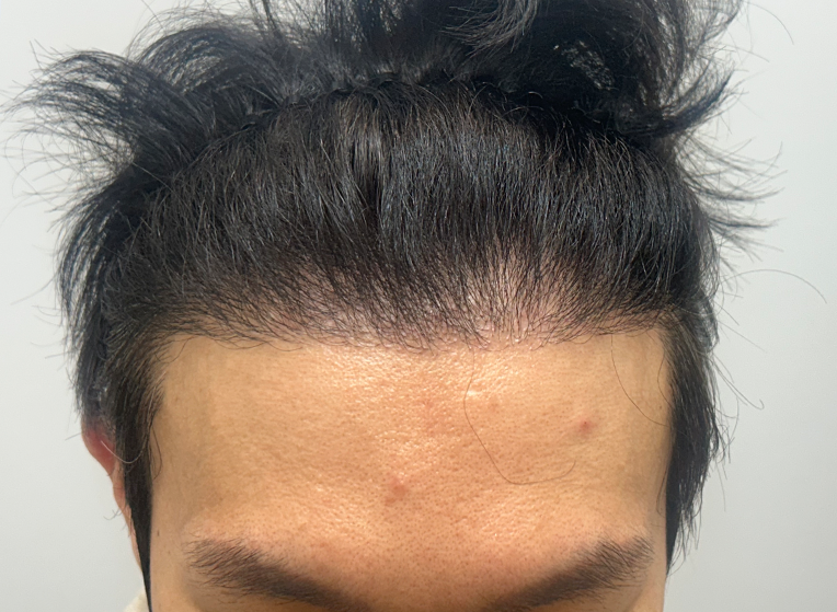 앞(후).png