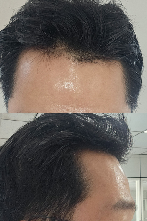모발이식전2.jpg 복사.jpg