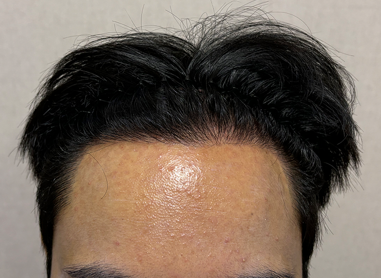 앞(후).png