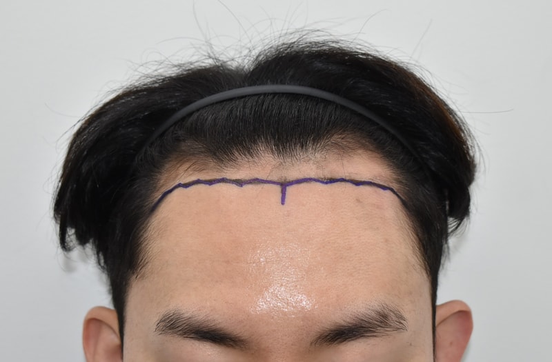 500-2026이창희__수술전디자인 (2).JPG