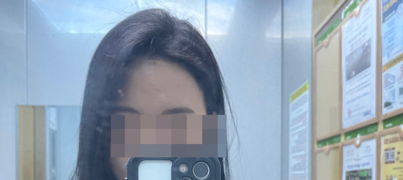 모발이식1년차3.png