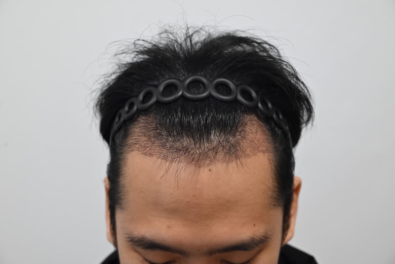 모발이식