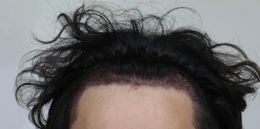수술후 2주후