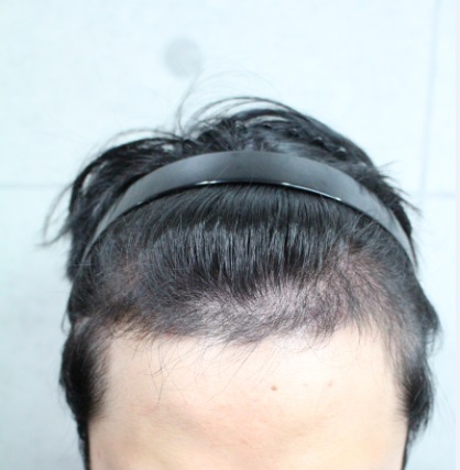 수술 후 1월.jpg