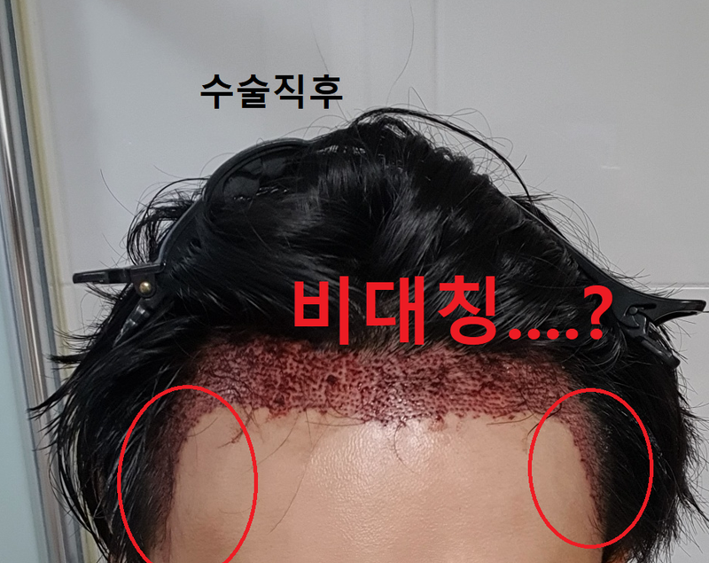 수술직후.png