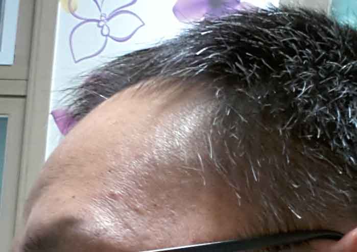 수술전측면.jpg