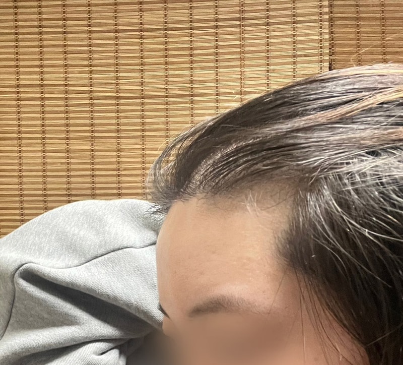 김나연-모발-241204_수술전.jpg