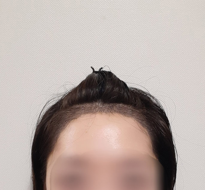 김규희_모발_240307_수술후1주_1.jpg