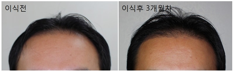 hairseeding.jpg