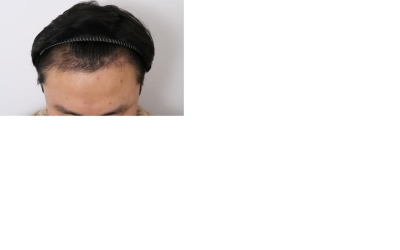 4개월경과-2.jpg