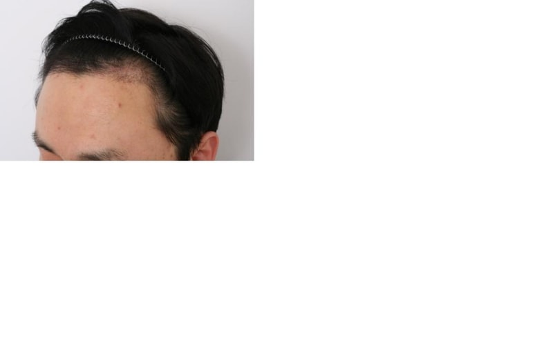 4개월경과-3.jpg