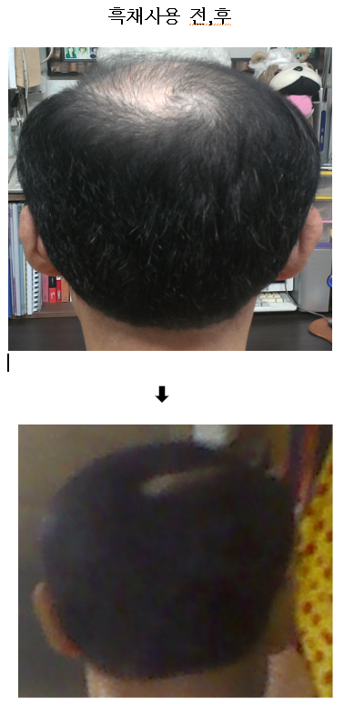 흑채사용전후사진(뒷면).png